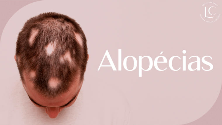 Alopécias