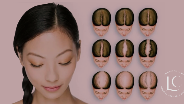 Alopecia androgenética feminina – o que você precisa saber sobre a calvície feminina