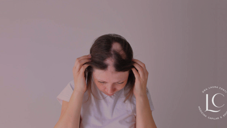 Falhas no cabelo: o que é alopecia areata? Veja causas e tratamento!