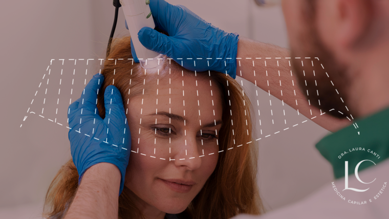 Tratamento Capilar com Laser Fracionado para Alopecia: Indicações e Resultados