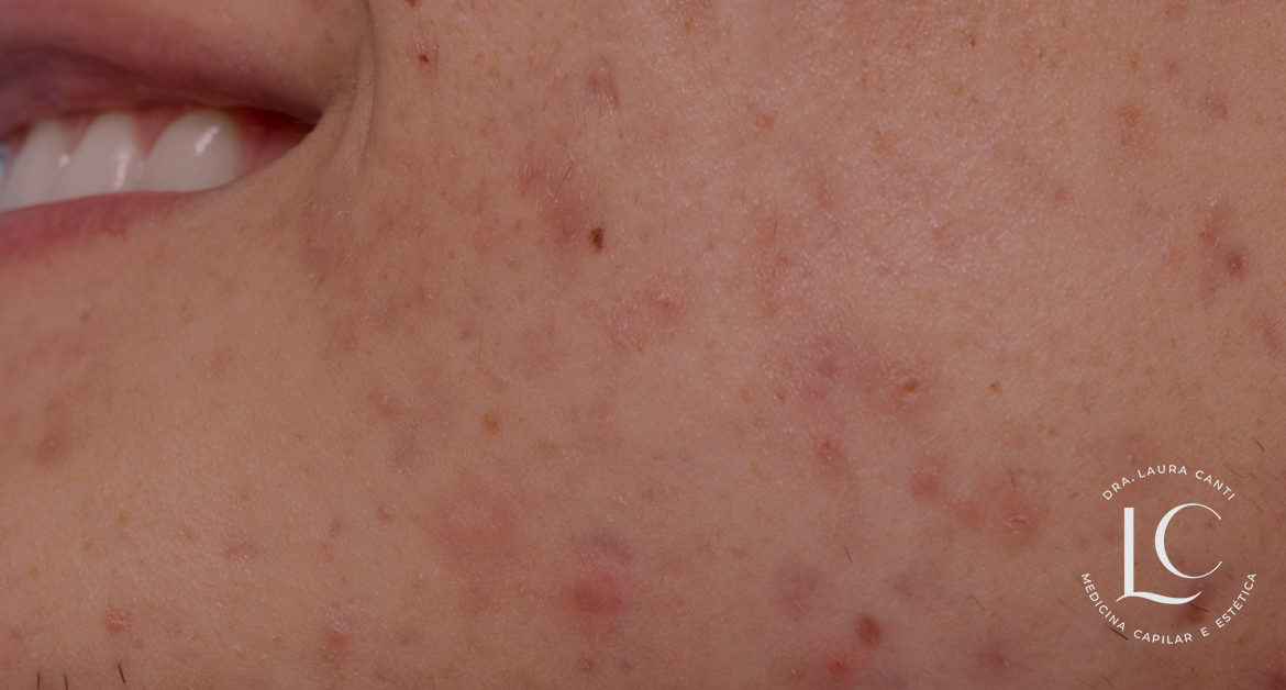 Mitos e Verdades Sobre cicatrizes de acne