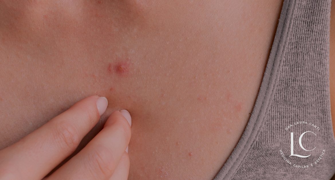 Acne no Colo: Normalidade e Estratégias de Controle